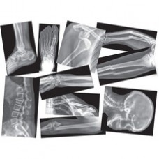 Roylco Broken Bones X-rays Set - Theme/Subject: Radiology - Skill Learning: Anatomy - 15 Pieces - 4+